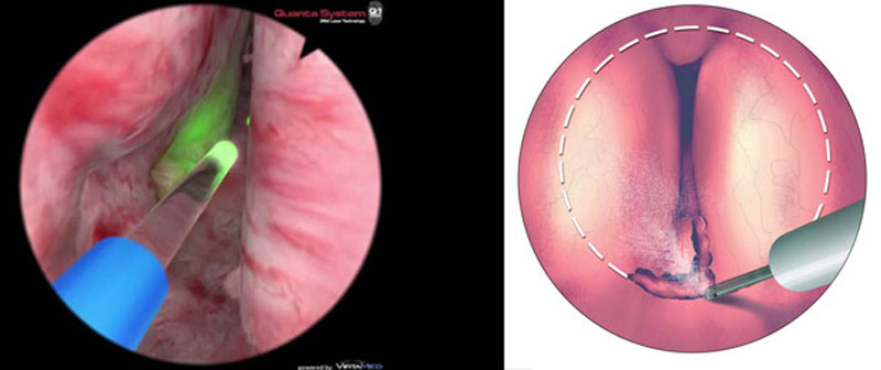 Kidney Stone Treatment in Calicut, Laser Kidney Stone Fragmentation