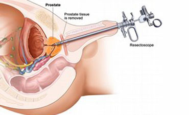 Best Prostate Laser Surgeon, Laser Prostate Surgery