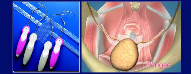 Laser Kidney Stone Fragmentation