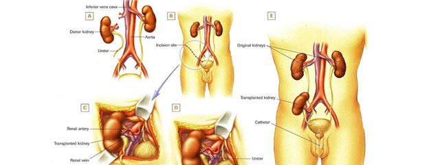 urology medical articles in kozhikode